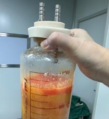 北流水动力吸脂手术要做多久？